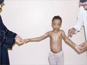 والدان يعذبان طفلهما بالماء المغلي ! "صورة"