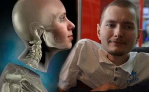 هل ستنجح أول جراحة بالعالم لزراعة رأس كامل؟