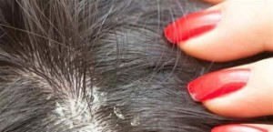 حل سحرى يخلصك من القشرة نهائياً