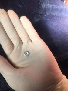 وزارة الصحة : صورة البرغي في سقف حلق طفل عارية عن الصحة.. وهذه التفاصيل !!