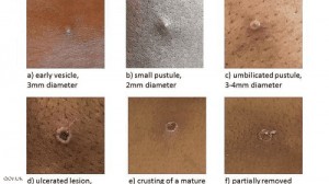 بريطانيا تواجه فيروسا نادرا ينتقل للإنسان