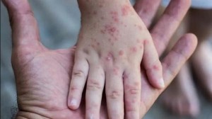 الصحة تعمم اعراض جدري القردة للحالات المشتبهة والمحتملة والمؤكدة