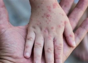 نتائج اجتماع الأوبئة بشأن جدري القرود وهذا ما اتفق عليه!