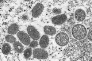 أول وفاة بمرض جدري القرود خارج إفريقيا