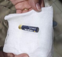 إخراج بطارية من بطن طفل