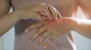 وداعا للأكزيما؟!.. اكتشاف السبب الرئيسي للحكة