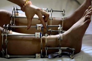 (عملية تطويل) تنهي حياة سعودي في تركيا